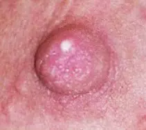 White Blister On Nipple